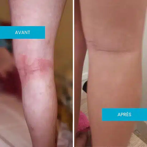Crème émolliente eczéma atopique 150 ml Laboratoires Téane